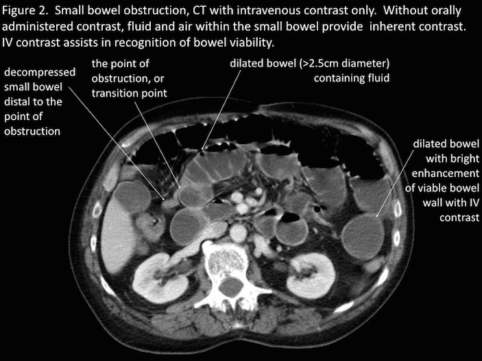 Ct Oral Contrast 62