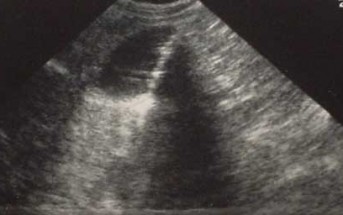 Imaging Artifacts: An ED Ultrasound Overview