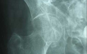 Hip Pain After Fall in Elderly Female