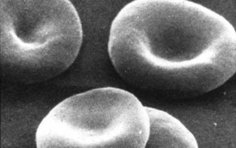 The Skinny on Sickle Cell Trait