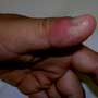 Red, swollen thumb. Is it MRSA?
