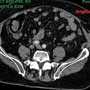 Traumatic Abdominal  Hernias: When to Operate