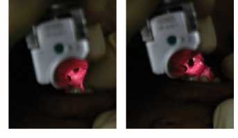 Demystifying Pediatric Laryngoscopy