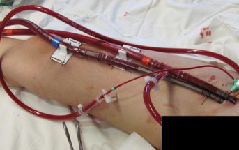 Bypass the OR: ECMO in the ED