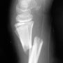 Does This Fracture Need to Be Reduced?