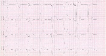 Fig-1-drug-shortage-ECG