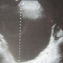 Five-Year-Old With Dysuria, Abdominal Pain and Incontinence