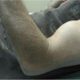 biceps-rupture-prev