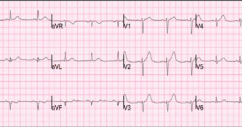 ECG 1