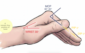 Distal Radius Fractures: Reducing the Confusion