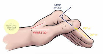 fractures 3 w