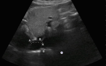 What’s Behind This Unexplained Hypotension? Check the Ultrasound