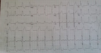 STEMI 1