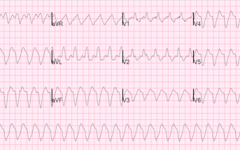 ECG Quiz: Very Wide and Very Fast