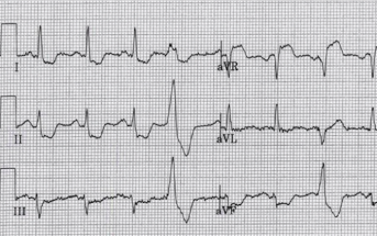 Interactive ECG: A Study in ST Elevation