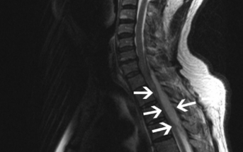 Diagnosing Spinal Epidural Abscesses