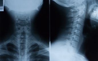 The Plain Cervical Spine X-Ray is Almost Dead