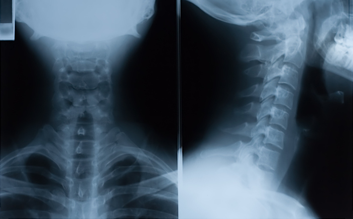 cervical spine xray