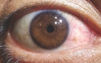 Case Study: Can You Name This Eye Problem?