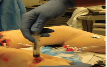 Ultrasound-Assisted Intraosseous Insertion