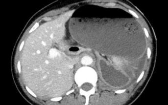 Gastric volvulus: A truly rare, but life-threatening cause of upper abdominal pain