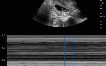 Bedside Ultrasound Evaluation in Right Lower Quadrant Pain