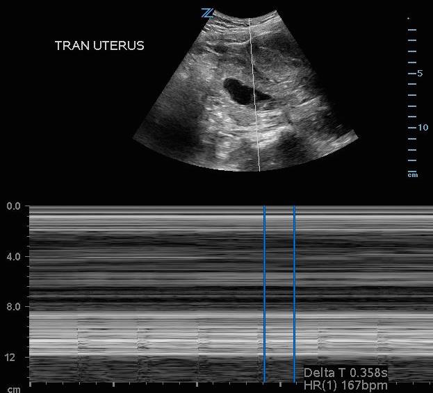 ectopic pregnancy -ultrasound 1