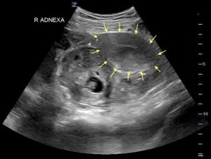 ectopic pregnancy -ultrasound 5