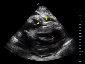 Cardiac Tamponade Image 1