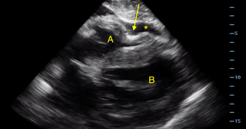 Cardiac Tamponade Image 1