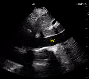 Cardiac Tamponade Image 2