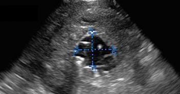 Back Pain in Elderly - Image 4 - AAA with thrombus 2 c incorrect measurement