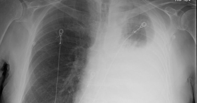 Left hemothorax pre chest tube_JMason-wm
