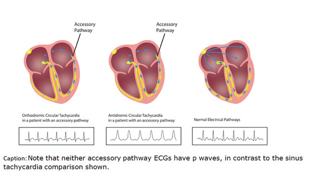 Treating WPW Syndrome