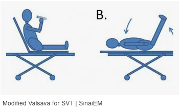 Modified Valsalva Maneuver for SVT | Emergency Physicians Monthly