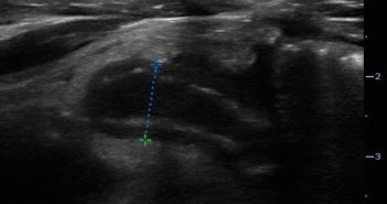 Abdominal pain in elderly - Image 1 - Appendicitis