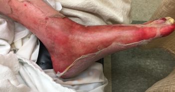 Dermatologic emergency -IMG_0273