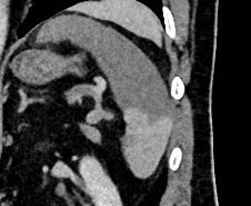 Splenic Infraction - Figure2