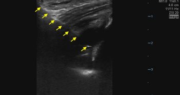 joint aspiration -Image 3