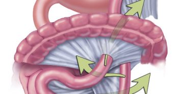 Acute abdominal pain s_p gastric bypass - figure 3