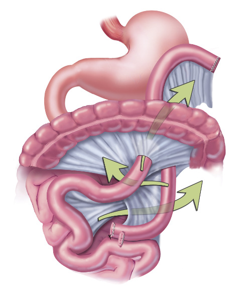 Acute abdominal pain s_p gastric bypass - figure 3