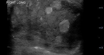 Testicular Torsion figures fig3