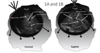 big head 1 Hydrocephalus EPM