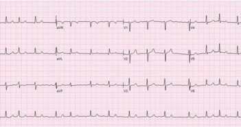 EM Coach_Thyroid Storm ECG_Atrial_Fibrillation_90_bpm