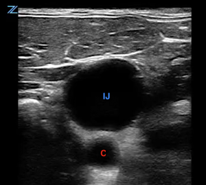 Ultrasound-Guided Peripheral Access: Part 2 | Emergency Physicians Monthly