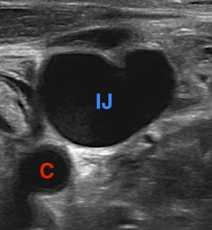 Ultrasound-Guided Peripheral Access: Part 2 | Emergency Physicians Monthly