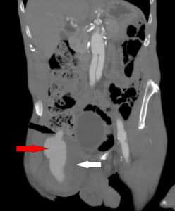 _figure 3 Sagital CT showing pseudoaneurysm(red arrow), thrombosed pseudoaneurysm(white arrow) and connection to the right common femoral artery(black arrow)