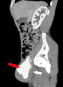 figure 4 Sagittal CT w_c showing the clotted portion of the pseudoaneurysm and the patent portion of the aneurysm