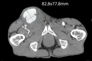 figure 5 Axial CT w_c showing pseudoaneurysm