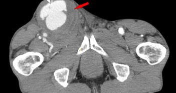 figure 6 Axial CT w_c showing the patent portion of the aneurysm containing contrast and clotted portion of the pseudoaneurysm